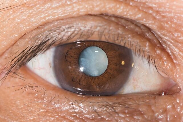 For cataracts, exercises are indicated to improve vision.