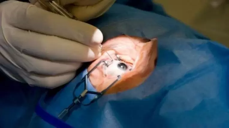 Vitrectomy – removal of the vitreous fluid from the eye